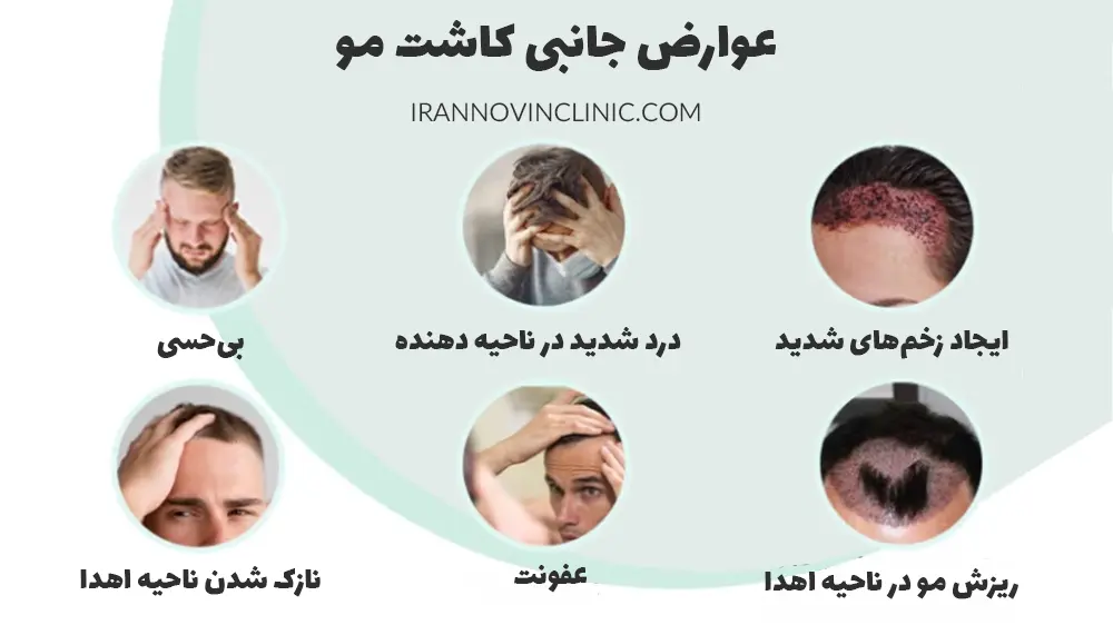 اینفوگرافیک عوارض کاشت مو