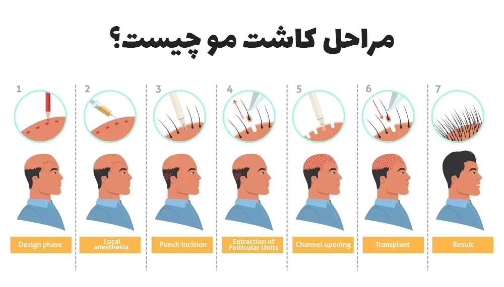 اینفوگرافیک مراحل کاشت مو